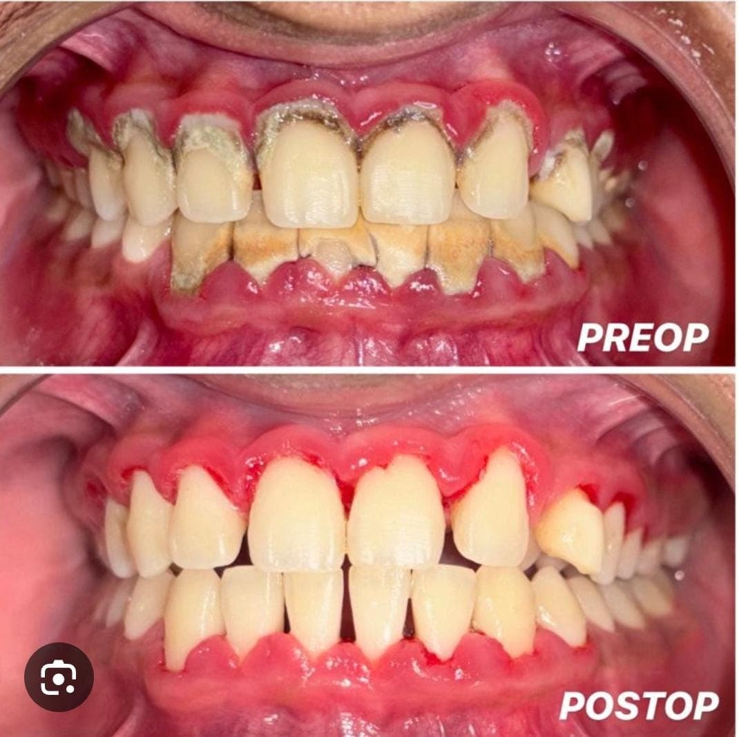 Before and after dental cleaning showing removal of heavy tartar and inflamed, red gums.