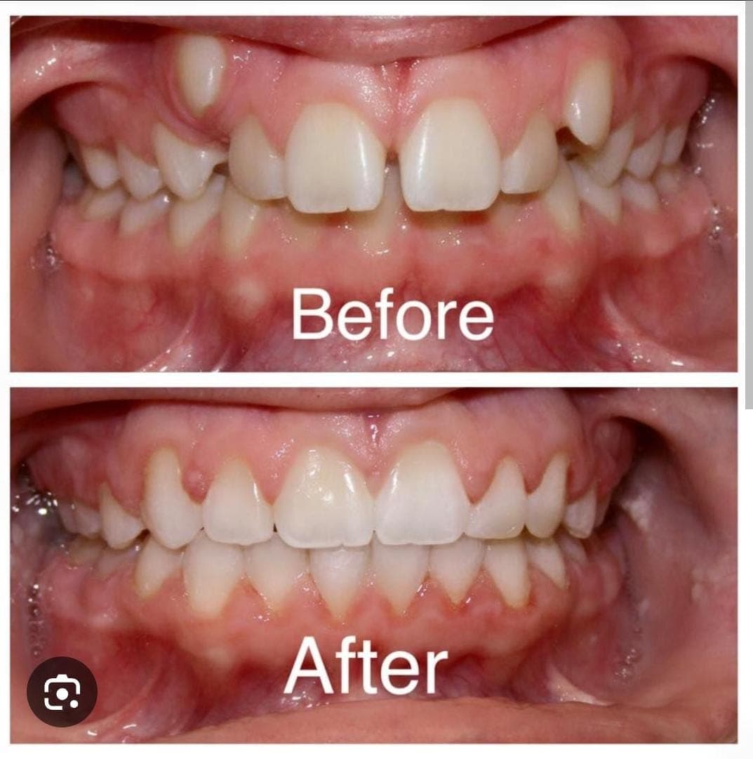 Before and after comparison showing crowded teeth and high canines corrected into a straight smile.