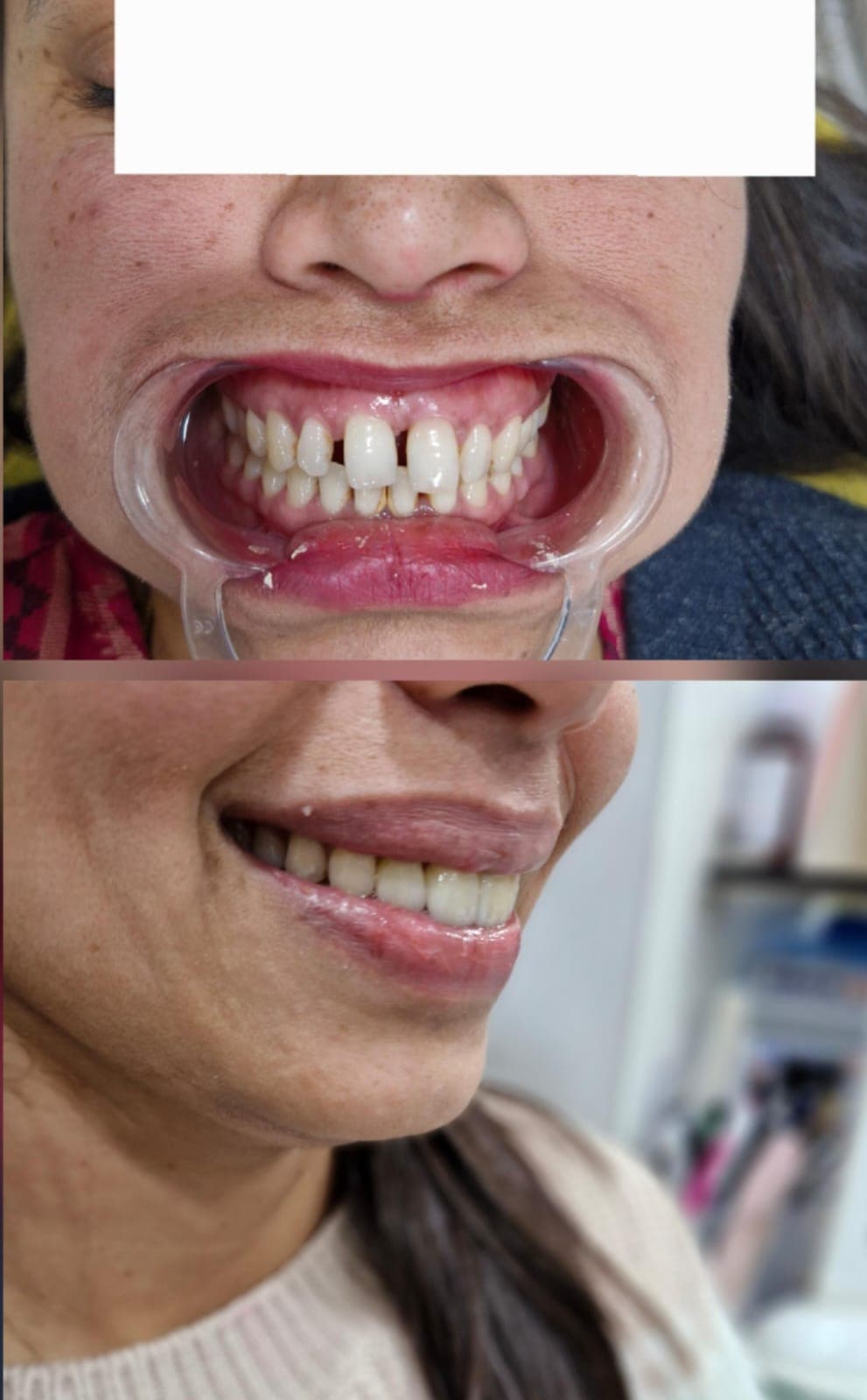Before and after dental comparison showing the closure of a gap between front teeth.